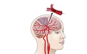 Új eljárást alkalmaztak akut stroke kezelésére a kaposvári kórházban