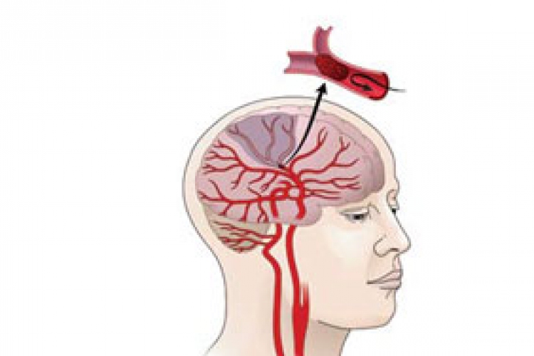 Új eljárást alkalmaztak akut stroke kezelésére a kaposvári kórházban