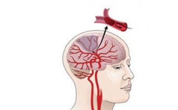 Új eljárást alkalmaztak akut stroke kezelésére a kaposvári kórházban